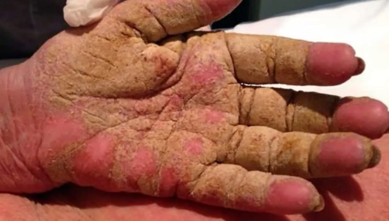 /especialista-de-la-ua-advierte-sobre-el-contagio-por-sarna-noruega-tras